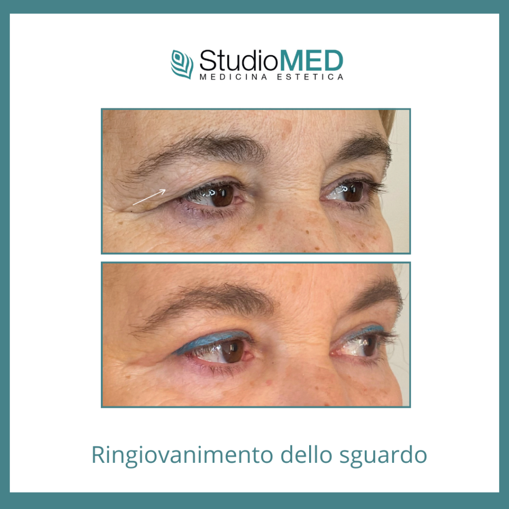 ringiovanire sguardo asti