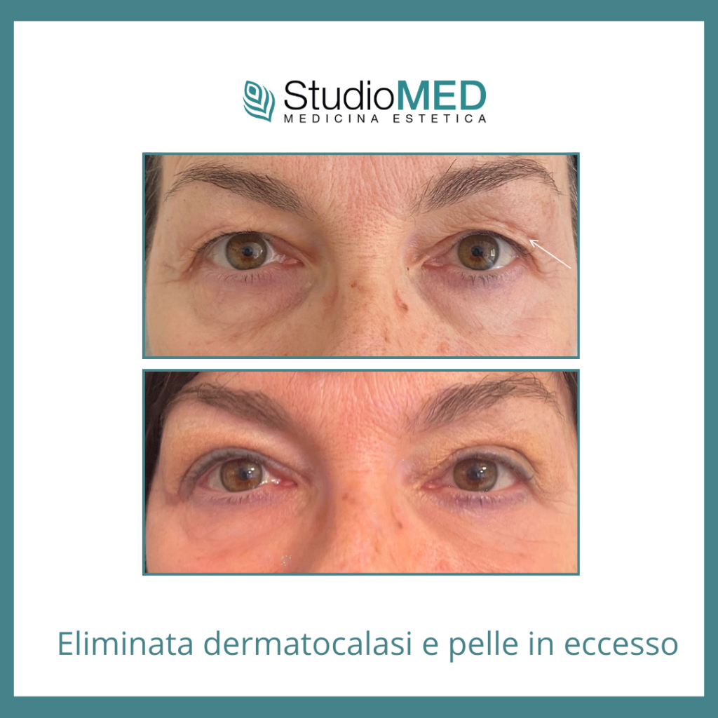 eliminare pelle in eccesso asti